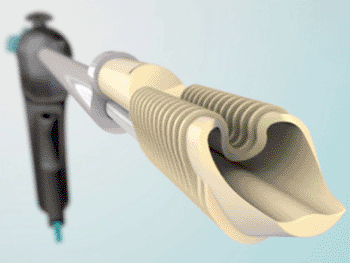 Image: The Eclipse Soft Tissue Anchor (Photo courtesy of MedShape). Image: The Eclipse Soft Tissue Anchor (Photo courtesy of MedShape).